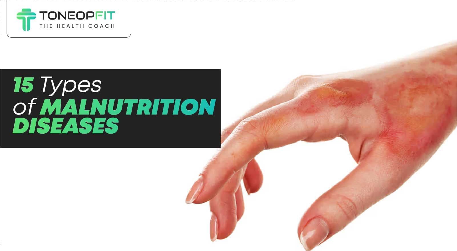 15 Types of Malnutrition Diseases & Low Protein-Energy Impact On Body!