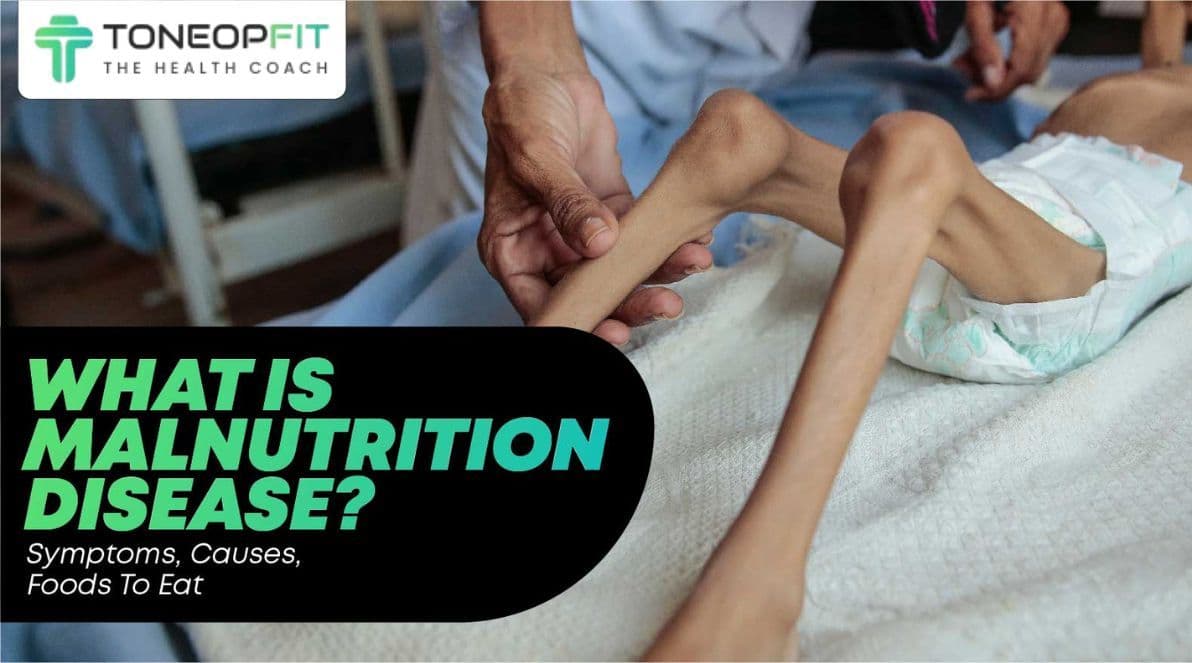 What Is Malnutrition Disease? Know The Symptoms, Causes, And Foods To Eat To Prevent It!