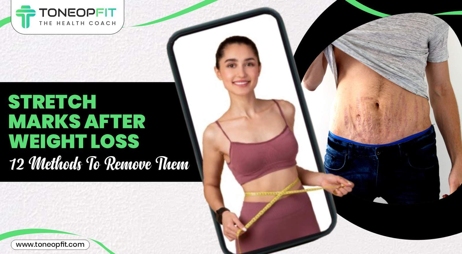 Stretch Marks After Weight Loss: 12 Methods To Remove Them